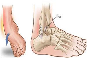 Lật sơ mi cổ chân không chỉ là bong gân nhẹ có thể kèm theo đứt- rách dây chằng, sưng đau dữ dội