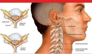 Thoát vị đĩa đệm cổ