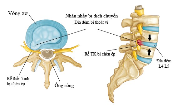 Tình trạng thoát vị đĩa đệm cột sống thắt lưng