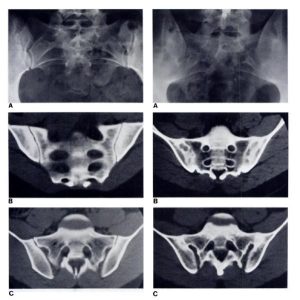Hình ảnh X-Quang viêm khớp cùng chậu qua từng giai đoạn