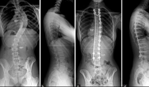 Chụp X-Quang cột sống phát hiện thoát vị đĩa đệm