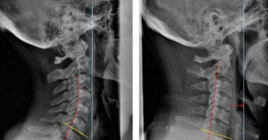 X-quang - gai đốt sống cổ