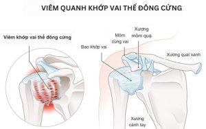 Viêm quanh khớp vai thể đông cứng