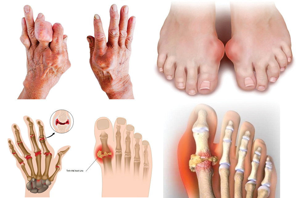 Bệnh Gout gây ảnh hưởng nghiêm trọng đến chức năng khớp