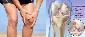 Dây chằng chéo ở đầu gối bị đứt hoàn toàn toàn