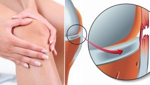 Giãn dây chằng chéo trước là tình trạng dây chằng bị kéo căng quá mức nhưng không bị đứt