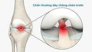 Chấn thương dây chằng chéo trước là nguyên nhân dẫn tới lỏng khớp gối