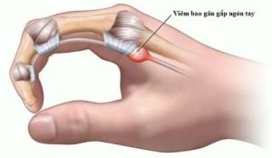 Hội chứng ngón tay lò xo