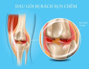 Tình trạng đầu gối bị rách sụn chêm