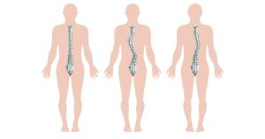Tình trạng vẹo cột sống ở người trưởng thành