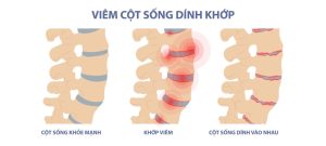 Hình ảnh so sánh cột sống khỏe mạnh và viêm cột sống dính khớp