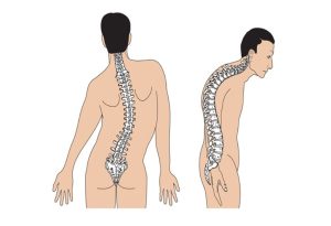 Cột sống bị cong vẹo