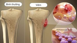 Xương bình thường (ảnh trái) và xương bị viêm (ảnh phải)