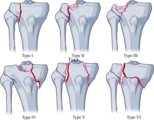 6 dạng gãy mâm chày theo hệ thống phân loại Schatzker