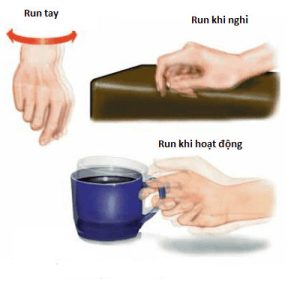 Run bàn tay là dấu hiệu tay bị mất vững