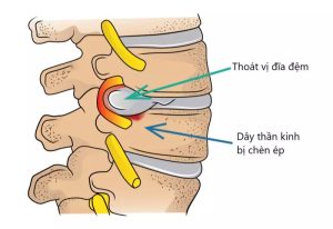 Tình trạng dây thần kinh bị chèn ép gây thoát vị đĩa đệm