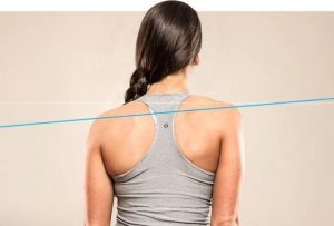 Tình trạng lệch vai hay còn gọi là “xệ vai”