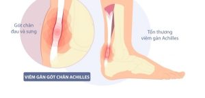 Tình trạng viêm điểm bám gân gót chân