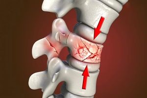 Xẹp đốt sống lưng